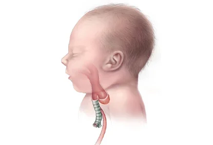 Everything You Must Know About Esophageal Atresia